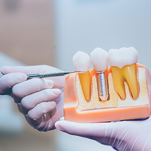 The image shows a person s hand holding a dental model with an open mouth, displaying teeth with a visible filling and a toothpaste tube with a toothbrush on top.
